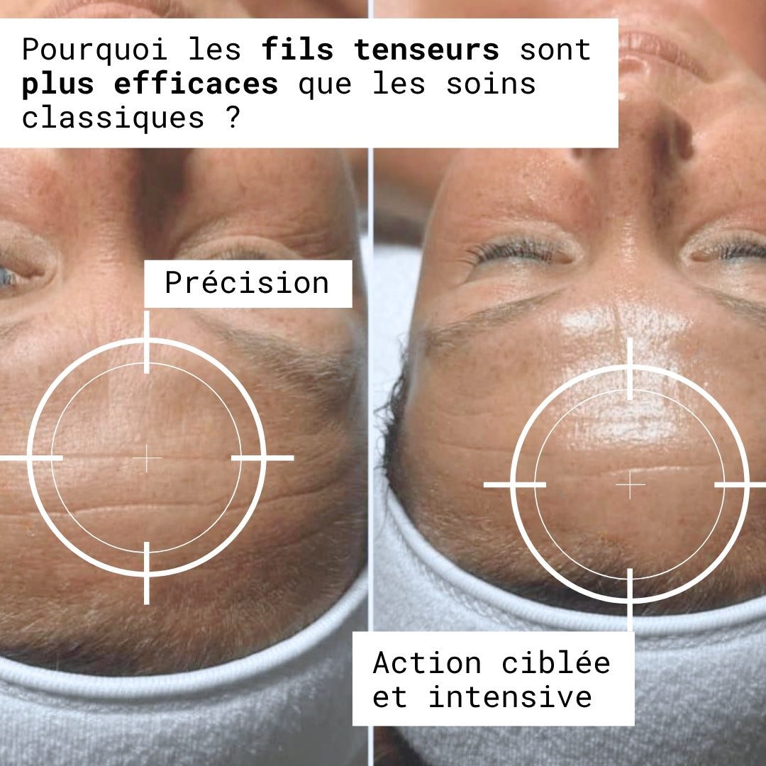 Fils tenseurs de collagène