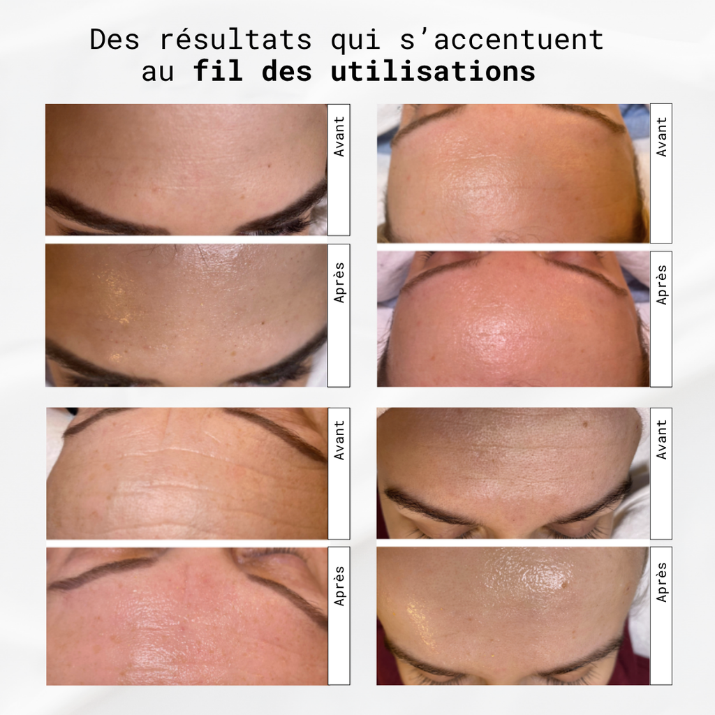 La cure de collagène