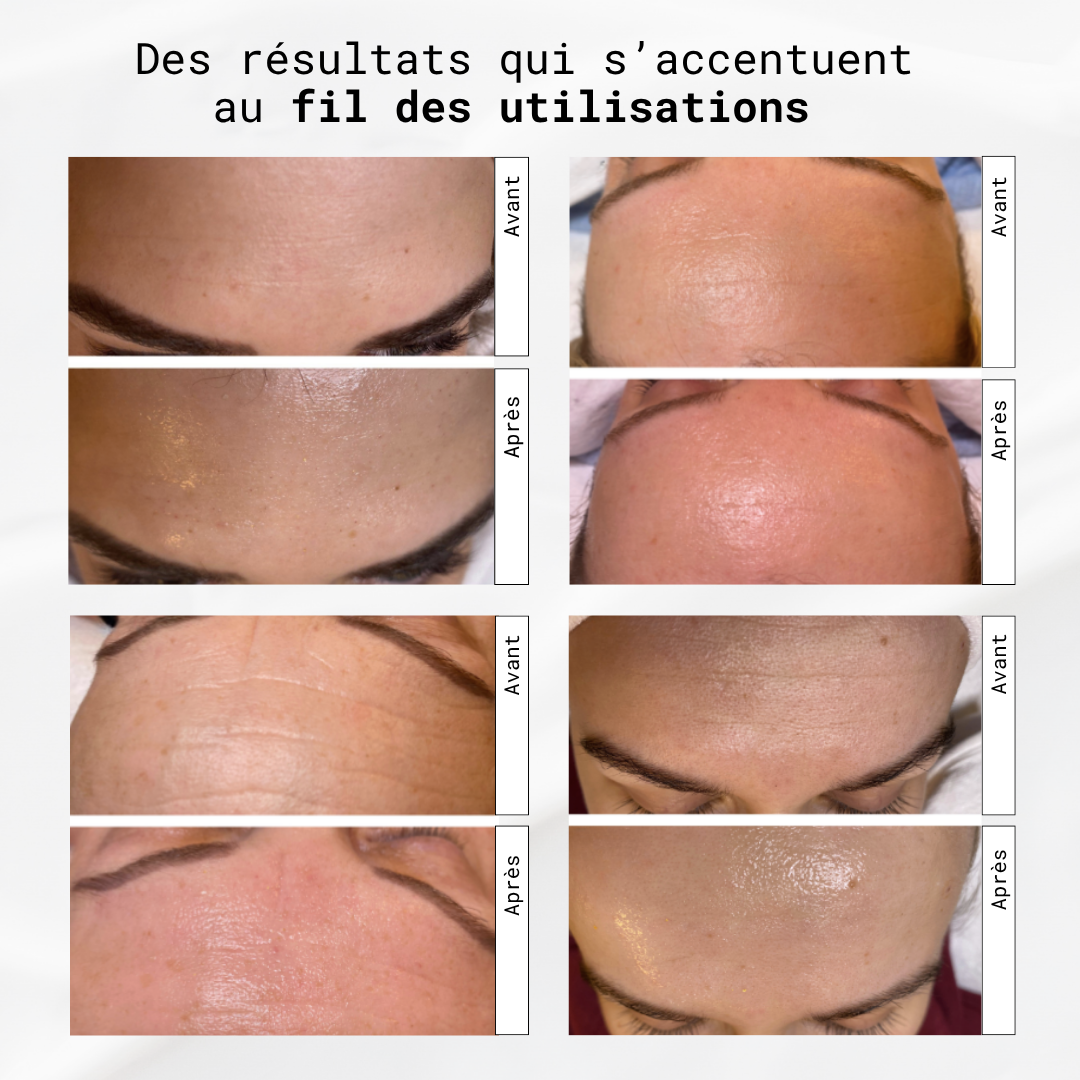 La cure de collagène