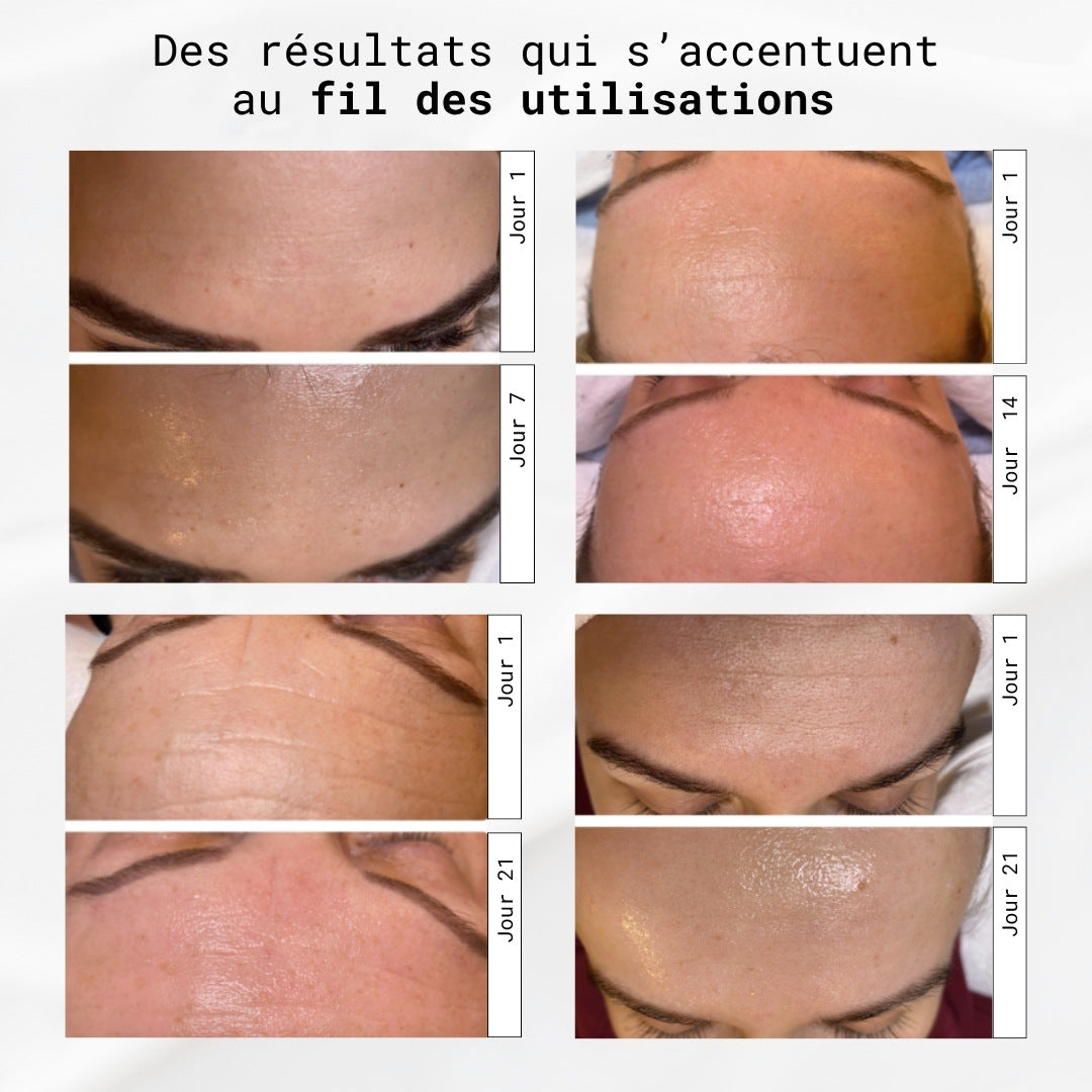 Fils tenseurs de collagène